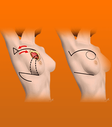 Local-Flaps_-Breast-Cancer