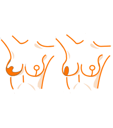 Reduction-Masthopexy