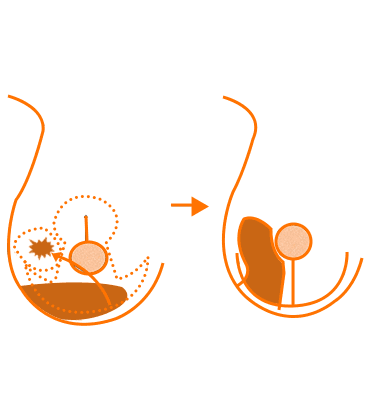 Therapeutic-Mammoplasty