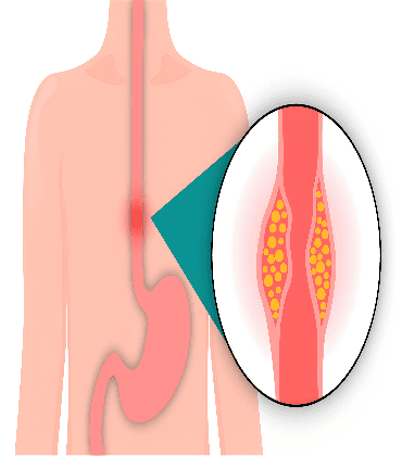 esophageal-Cancer