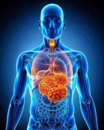 hepatocellular-carcinoma