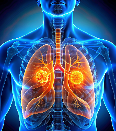lung-cancer
